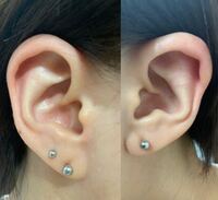 ピアスを開けたいと思い軟骨用ピアッサー買ってきました ニードルより痛い Yahoo 知恵袋