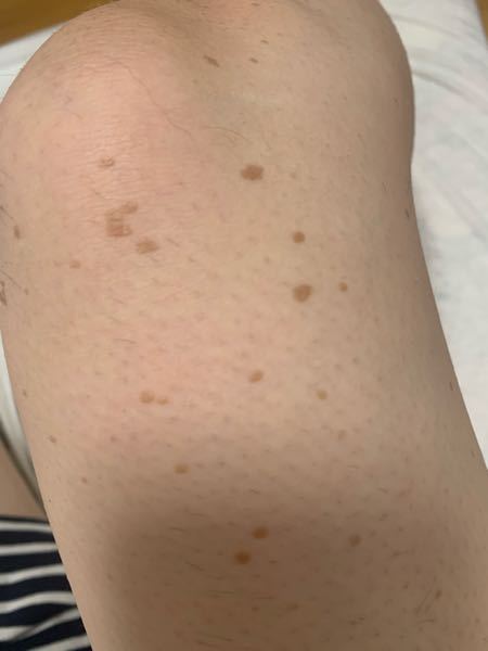 足の画像閲覧注意 右足のふくらはぎと太ももにかけて茶色の小さい Yahoo 知恵袋