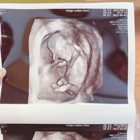 現在妊娠4ヶ月なのですが この足の付け根に見えるのは 男の子でしょうか Yahoo 知恵袋