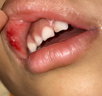 6歳の子供の唇の粘膜に赤いものができましたがこれはなんなので Yahoo 知恵袋