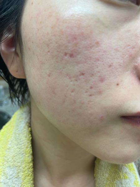 ハチミツ毎日食べたら肌荒れ治りますか 美肌効果ってありますか Yahoo 知恵袋