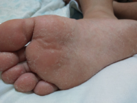 お風呂上がりの足の裏が 皮が向けてポロポロなのですが水虫の類 Yahoo 知恵袋