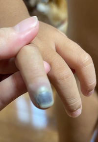 3歳の子供が8月26日にドアに指を挟み 冷やしたりしていましたが 今こ Yahoo 知恵袋