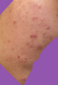 中二女子です ニキビが頬に大量にできてしまいました 自分なりに原 Yahoo 知恵袋