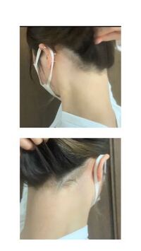 湘南美容外科で うなじの医療脱毛を行いました 写真にあ Yahoo 知恵袋