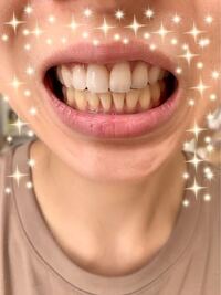 再矯正について 数年前に矯正したのですが ちゃんとリテーナーを使 Yahoo 知恵袋