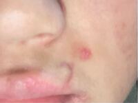 バイクで事故して顔に傷跡がついたのですがそのまま放置してしま Yahoo 知恵袋