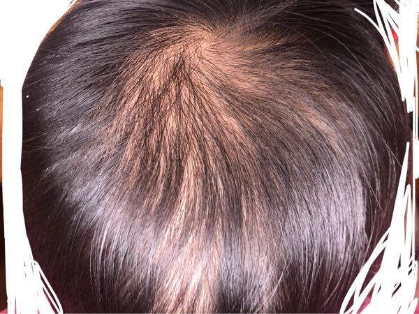 皮膚むしり症について 私は頭皮を剥くことがやめられず 頭 Yahoo 知恵袋