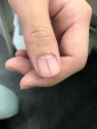 手の親指に写真のような黒い縦線ができました この数ヶ月で爪の根本 Yahoo 知恵袋