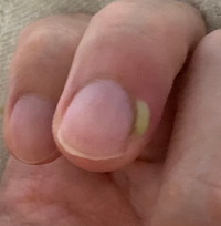 爪の横に膿のようなものが溜まってきたのですが これは放置していて大丈夫 Yahoo 知恵袋