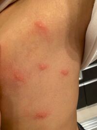 朝起きたら6箇所ぐらい出来物ができたのですが ダニではなさそ Yahoo 知恵袋