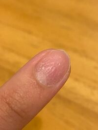 1ヶ月前くらいから左手の人差し指と中指の爪が写真のようにボコ Yahoo 知恵袋