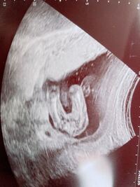 エコー写真の性別について 今のところ女の子っぽいでしょうか Yahoo 知恵袋