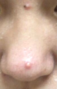 画質悪くてすみません肌についてる白いものは乳液ですこの鼻の大きいニキビ Yahoo 知恵袋