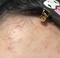 助けてください 最近おでこにニキビ が増えました 学校で Yahoo 知恵袋