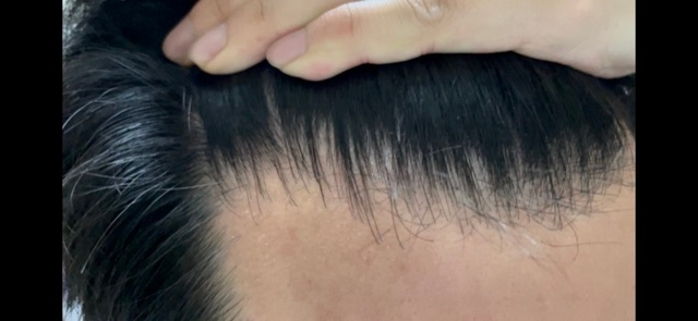 ギザギザ生え際は薄毛 こういう生え際の人って薄毛なの Yahoo 知恵袋
