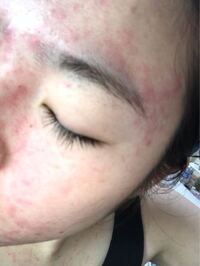 このような発疹が顔全体と胸元に現れてしまいました 痒みはありません Yahoo 知恵袋