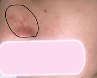 小鼻にたくさんニキビが出来ました 原因あるのでしょうか Yahoo 知恵袋