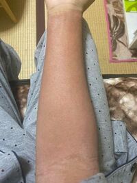 アトピーで炎症後色素沈着に悩んでます こういった焦げ茶っぽい Yahoo 知恵袋