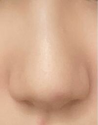 団子鼻ですか？ 団子鼻の基準はなんですか？