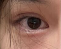 埋没4日目ですが、かなり幅が広く目も開きにくいです。これから本当に幅って狭くなってくれるのでしょうか？経験された方、詳しい方お聞かせください。 