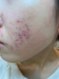 ディフェリンゲルを使って1ヶ月経つのですが余計悪化してしまい Yahoo 知恵袋