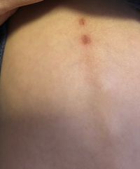 入浴後に背中をみたら背骨に沿ってあざがあるのを発見しました 以 Yahoo 知恵袋