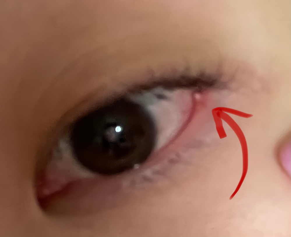 マイボーム腺なんたらというやつでしょうか 1年以上前 下手したらもっと Yahoo 知恵袋