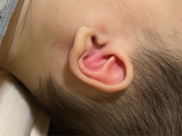 生後6ヶ月赤ちゃん耳が赤いです さっきお風呂入る前に子 Yahoo 知恵袋