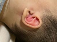 生後6ヶ月 赤ちゃん 耳が赤いです。 さっきお風呂入る前に子供が両耳をさわってるのをみて、耳を見ると中が赤かったです。
痛がったり泣いたりはしてません。
なんの症状でしょうか？？

なにかのアレルギー反応でしょうか？
中耳炎でも赤くなることはありますか？

思い当たることは、午前中の離乳食で
初めてかぼちゃとさつまいものペーストを
食べたくらいです。（市販のもの）
かぼちゃはだけのペーストは...