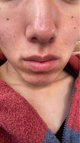 脂漏性皮膚炎でもう4.5年悩んでますなにやっても効果ないです 