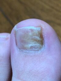 爪アップ画像注意 夏に厚底を履き その後内出血 したとこ Yahoo 知恵袋