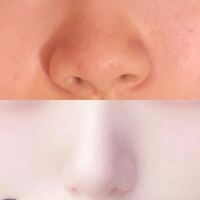 鼻尖形成と鼻翼縮小だけで上から下の鼻にすることは可能でしょう Yahoo 知恵袋