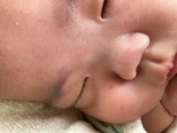 生後2ヶ月の赤ちゃんです 退院してから鼻の黒ずみが2個あった Yahoo 知恵袋