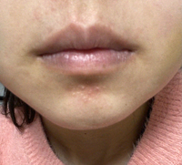 口周りの色素沈着と顎のぶつぶつが気になります 胃が弱く敏感肌 Yahoo 知恵袋