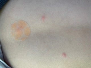 6歳男の子です。これは水疱瘡ですか??2週間前に同じクラスの子がなって 