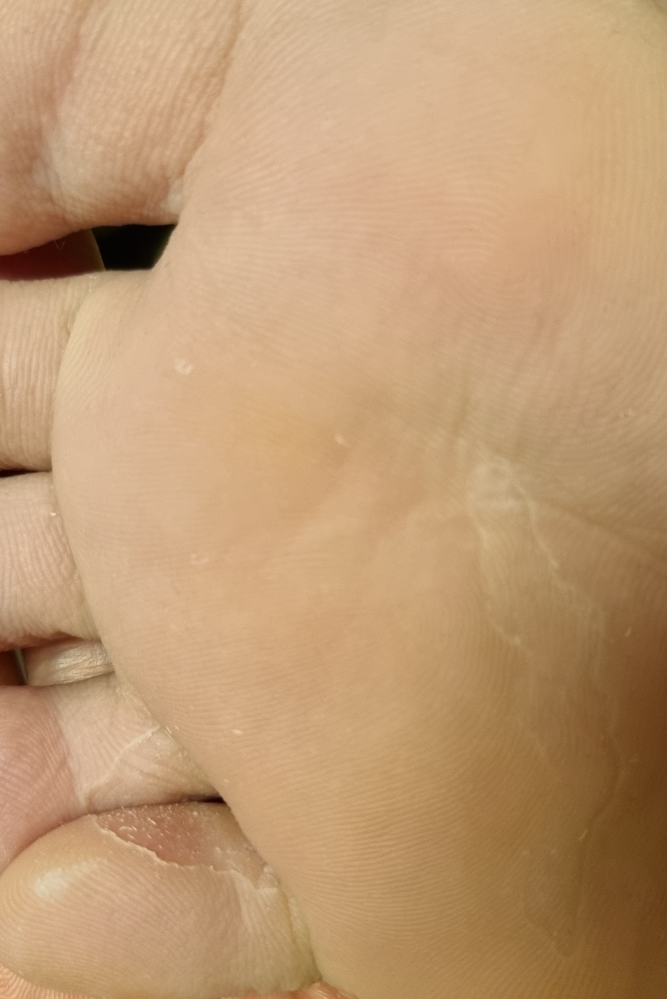 ふやけると足の小指と薬指の間の皮、足裏がこんな状態、数年続いています。痒くはなく、放置してました。治療が必要ですか？