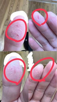 バイト先の洗剤のせいで手が荒れてきました 赤丸のように 指の Yahoo 知恵袋