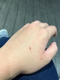 親指にシャー芯がささったんですが何科へ行けばいいですか 昨日 ささ Yahoo 知恵袋