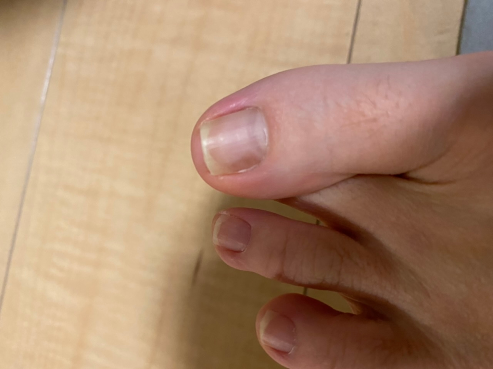 足の親指の爪が変色しているのですが、これは水虫っぽいですか？？ 頻繁に足の指を打ったりするので、内出血なのかな？とも思うのですが。 近いうち、皮膚科にはいこうと思っているのですが、心配で。