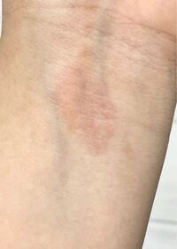香水をつけると 皮膚が赤くなってかぶれてしまいます わたしは現在高校２年生で Yahoo 知恵袋