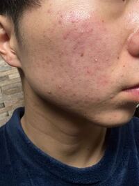 ニキビがなかなか治りません 毎日洗顔しています 朝はぬ Yahoo 知恵袋