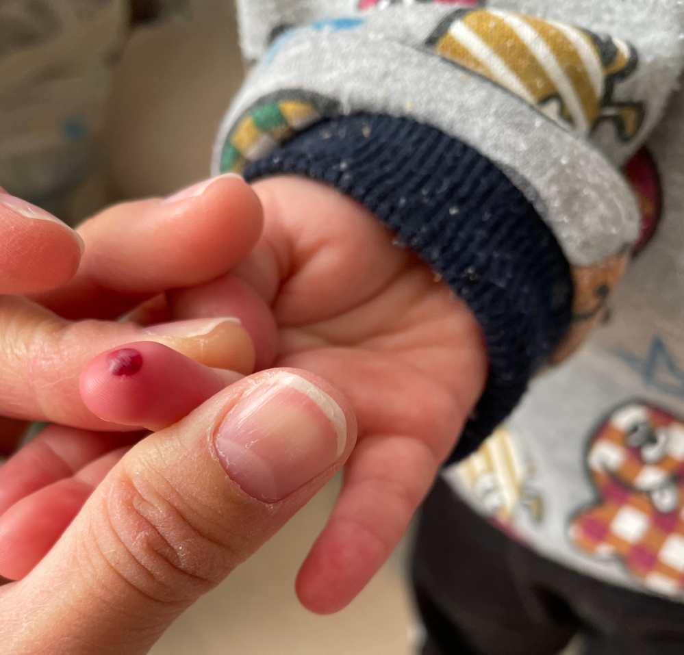 一歳半の子供がいるのですが今手を見たら血豆のようなものがあり Yahoo 知恵袋