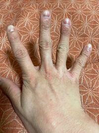 至急 至急 私は今中学3年の男です 私の手は写真の通りしわし Yahoo 知恵袋