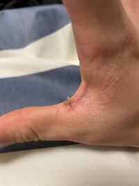 バーベルを握ったりしてたら親指と人差し指の間にアザが出来てめちゃくちゃ Yahoo 知恵袋