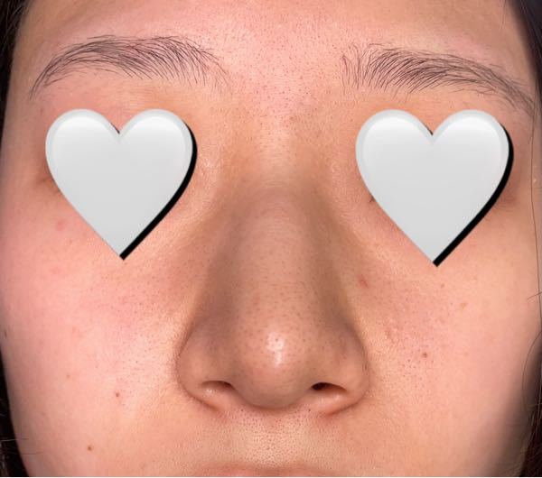 閲覧注意⚠ この肌を見てください。 眉の間や頬、鼻の点々（毛穴？） どうすれば治りますか？？