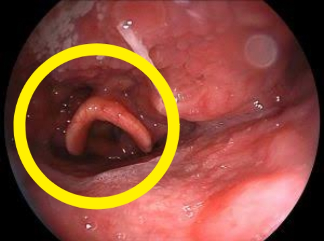 喉にこの画像と同じ変な突起物が見つかりました。中咽頭あたりなのですが、これってなにかの病気でしょうか？それとも中咽頭にはこういうのがあるもんなんでしょうか？ ちなみに最近あった事といえば… ・ポ...