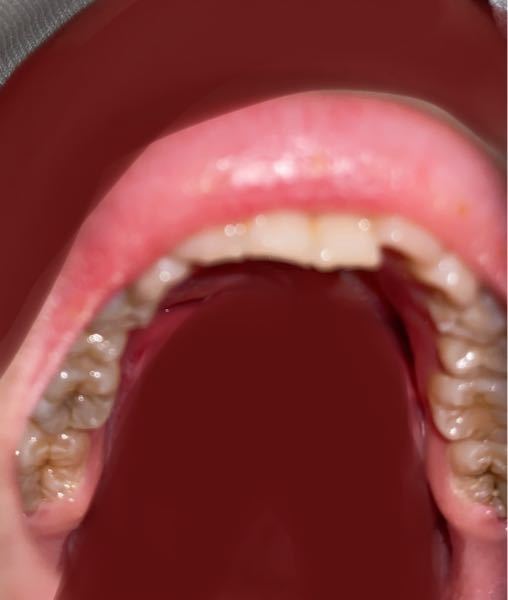 これって虫歯ですか？