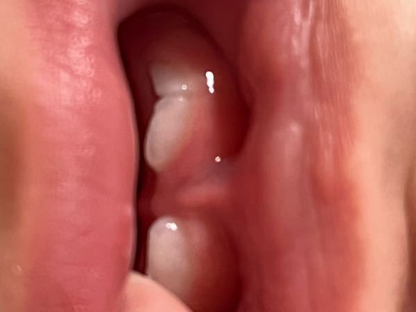 8ヶ月の息子の上の歯です。 多分、前歯が1本はえるはずの場所から2本出てきてます。 これは歯医者または小児科に行くべきでしょうか？ 様子見ですか？