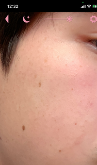 高校生なのですがほっぺにシミ そばかすがいっぱいあって嫌なんですが自分 Yahoo 知恵袋